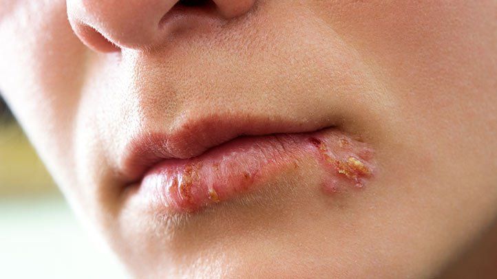 cold-sores-symptoms-diagnosis-722x406.jpg