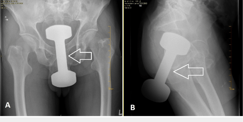 Rectal-dumbbell-arrow-on-abdominal-plain-films-A-antero-posterior-view-and-B.png